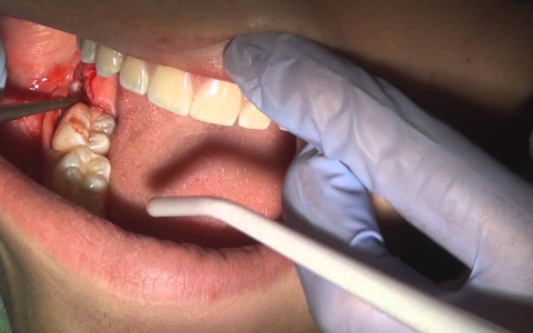 Nhổ răng khôn hàm dưới: khi nào nên nhổ và cần chú ý những gì?