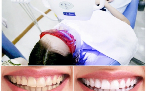 Chi phí tẩy trắng răng bao nhiêu tiền? Ở đâu uy tín?